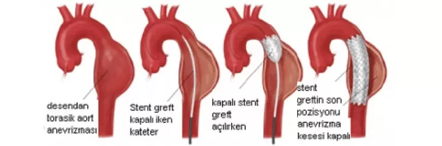 Anevrizma Türleri Nelerdir?