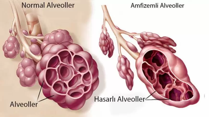 Amfizem Türleri Nelerdir?