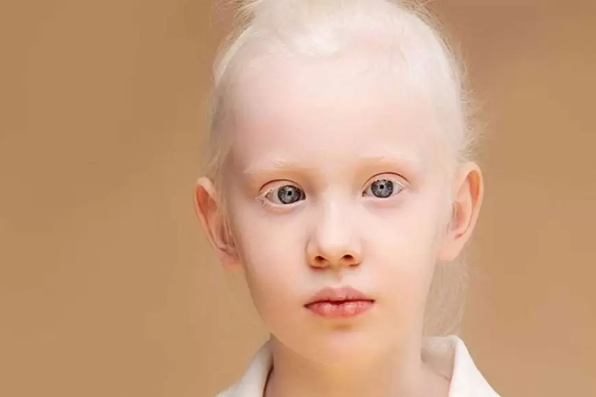 Albinizm (Albino) nedir? Tedavisi var mıdır?